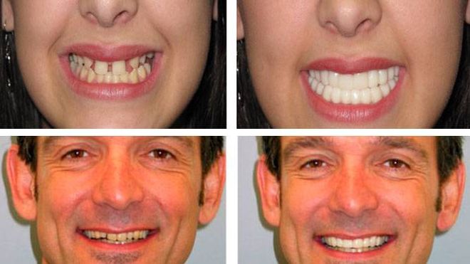 До и после использования виниров Dr.Smile